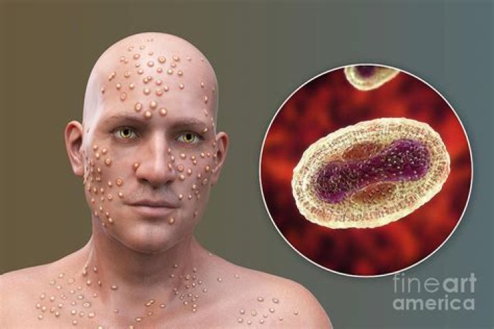 Smallpox Pictures That Reveal The Disease's Devastating History